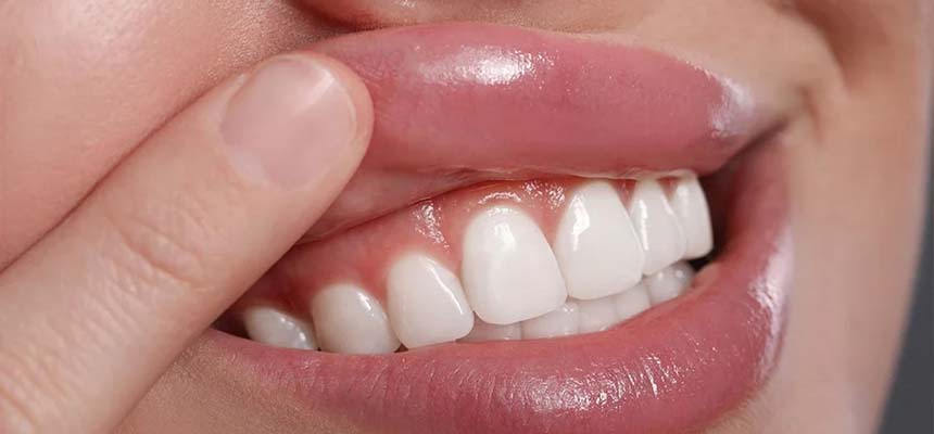 C4:歯質が失われたう蝕